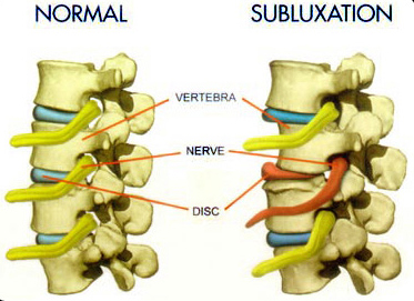 Subluxation Subluxation