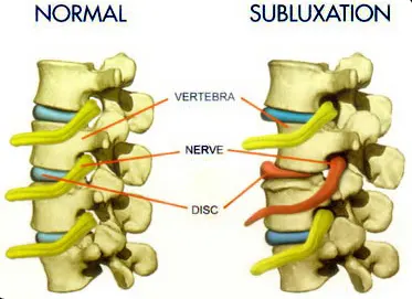 Subluxation