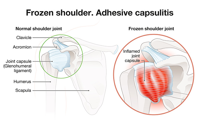 West Side Comprehensive Chiropractic Care - Frozen Shoulder Pain
