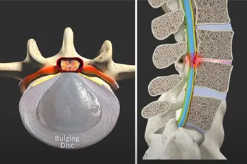 Lumbar Traction Lumbar Traction